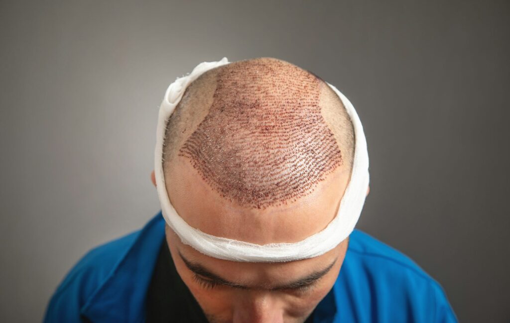 Hair transplant in Islamabad