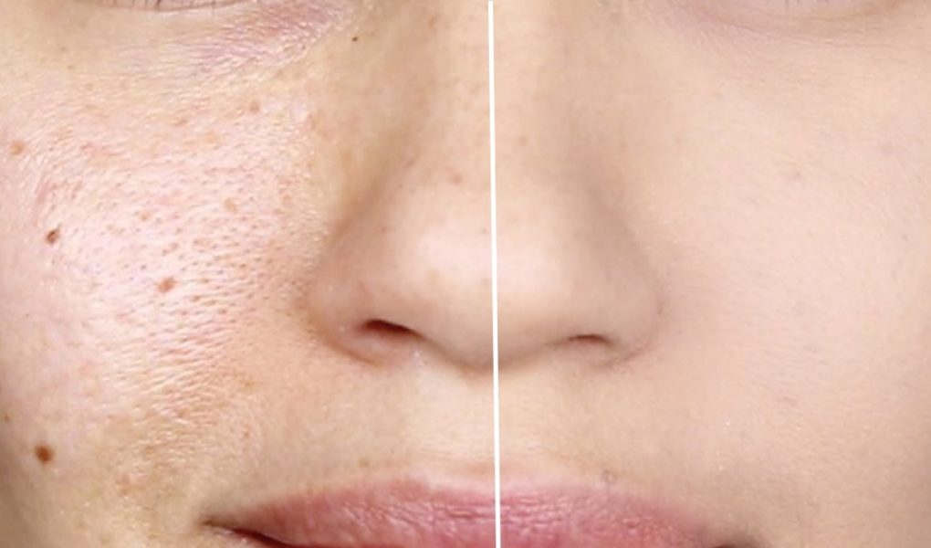Large pore treatment designed for dry skin
