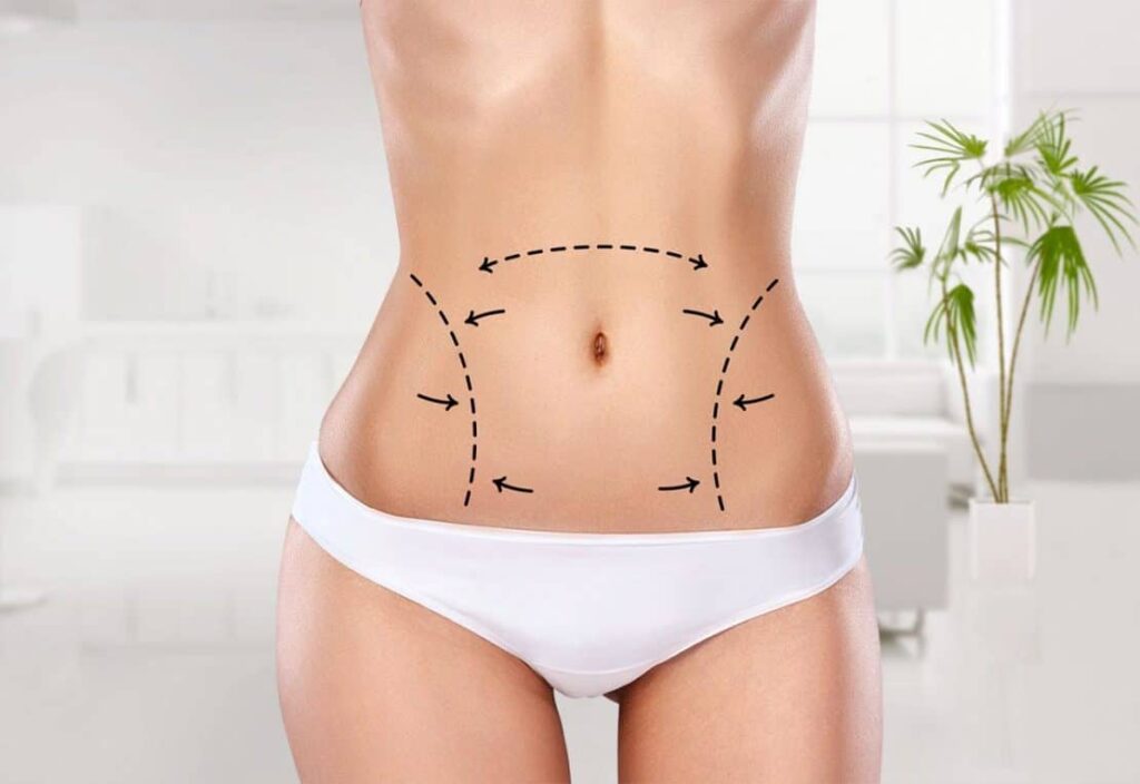 Latest Advances in Liposuction Technology (2025 Update)