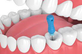Save infected tooth