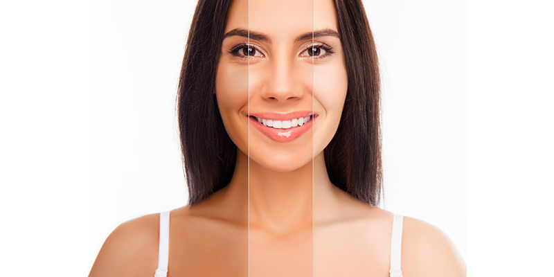 Skin whitening in Islamabad