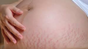 Stretch mark laser therapy