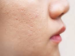 Treat acne damage