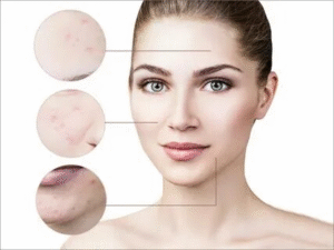 Acne Medication in Itasca
