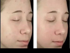 Acne Medication in Itasca