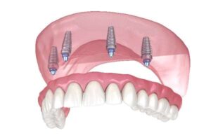 dental implants Kirkcaldy