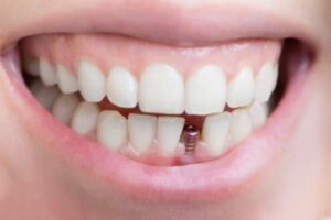 dental implants Dumfries