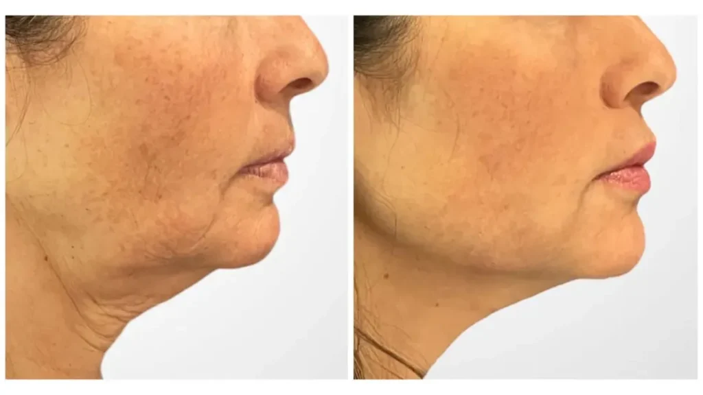 Is Thread Lift Worth It? Honest Answers from the Best Aesthetic Clinic in Dubai